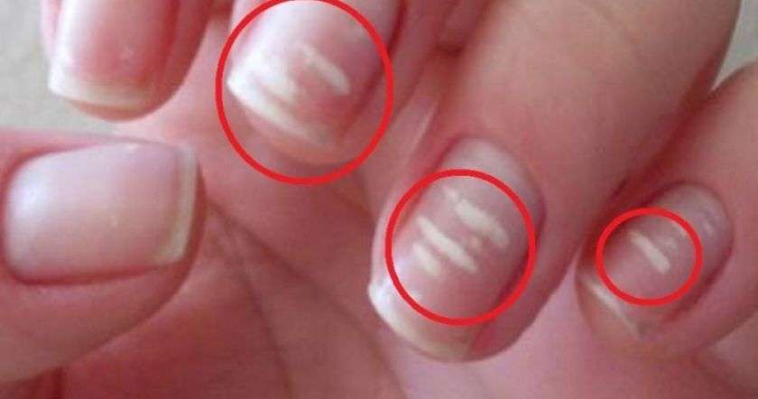 Белые следы на ногтях